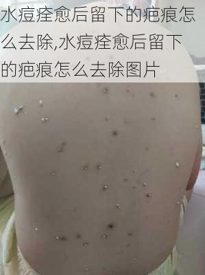 水痘痊愈后留下的疤痕怎么去除,水痘痊愈后留下的疤痕怎么去除图片