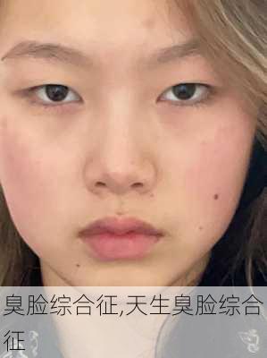 臭脸综合征,天生臭脸综合征